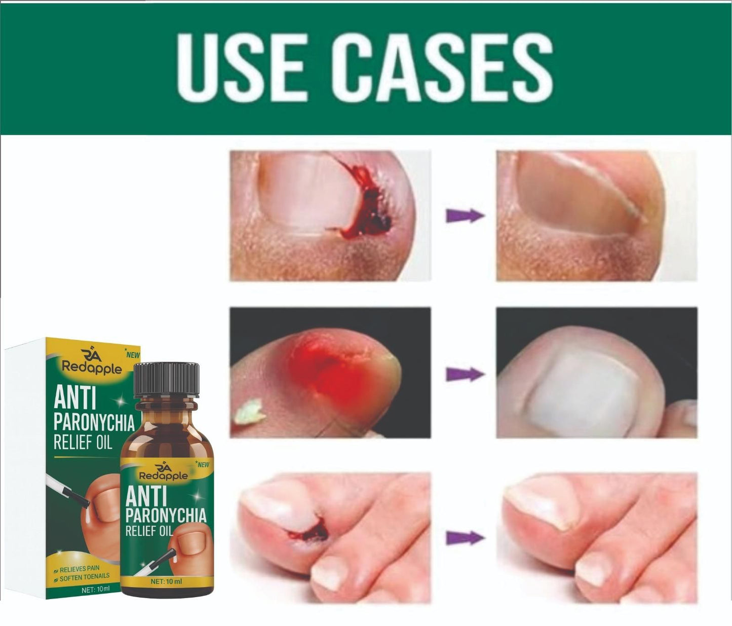 Anti Paronychia Relief Oil