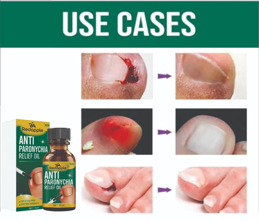 Anti Paronychia Relief Oil